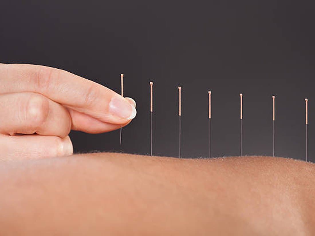 Fine acupuncture needles placed along a patient arm during treatment